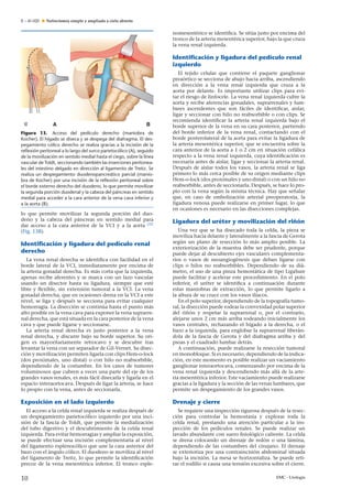 E – 41-020 Nefrectomía simple y ampliada a cielo abierto
A B
Figura 13. Acceso del pedículo derecho (maniobra de
Kocher). El hígado se diseca y se despega del diafragma. El des-
pegamiento cólico derecho se realiza gracias a la incisión de la
reﬂexión peritoneal a lo largo del surco parietocólico (A), seguido
de la movilización en sentido medial hasta el ciego, sobre la línea
vascular de Toldt, seccionando también las inserciones peritonea-
les del intestino delgado en dirección al ligamento de Treitz. Se
realiza un despegamiento duodenopancreático parcial (manio-
bra de Kocher) por una incisión de la reﬂexión peritoneal sobre
el borde externo derecho del duodeno, lo que permite movilizar
la segunda porción duodenal y la cabeza del páncreas en sentido
medial para acceder a la cara anterior de la vena cava inferior y
a la aorta (B).
lo que permite movilizar la segunda porción del duo-
deno y la cabeza del páncreas en sentido medial para
dar acceso a la cara anterior de la VCI y a la aorta [32]
(Fig. 13B).
Identiﬁcación y ligadura del pedículo renal
derecho
La vena renal derecha se identiﬁca con facilidad en el
borde lateral de la VCI, inmediatamente por encima de
la arteria gonadal derecha. Es más corta que la izquierda,
apenas recibe aferentes y se marca con un lazo vascular
usando un disector hasta su ligadura, siempre que esté
libre y ﬂexible, sin extensión tumoral a la VCI. La vena
gonadal derecha, que en ocasiones drena en la VCI a este
nivel, se liga y después se secciona para evitar cualquier
hemorragia. La disección se continúa hasta el punto más
alto posible en la vena cava para exponer la vena suprarre-
nal derecha, que está situada en la cara posterior de la vena
cava y que puede ligarse y seccionarse.
La arteria renal derecha es justo posterior a la vena
renal derecha, y discurre bajo su borde superior. Su ori-
gen es mayoritariamente retrocavo y se descubre tras
levantar la vena con un separador de Gil-Vernet. Su disec-
ción y movilización permiten ligarla con clips Hem-o-lock
(dos proximales, uno distal) o con hilo no reabsorbible,
dependiendo de la costumbre. En los casos de tumores
voluminosos que cubren a veces una parte del eje de los
grandes vasos renales, es más fácil disecarla y ligarla en el
espacio interaortocava. Después de ligar la arteria, se hace
lo propio con la vena, antes de seccionarla.
Exposición en el lado izquierdo
El acceso a la celda renal izquierda se realiza después de
un despegamiento parietocólico izquierdo por una inci-
sión de la fascia de Toldt, que permite la medialización
del tubo digestivo y el descubrimiento de la celda renal
izquierda. Para evitar hemorragias y ampliar la exposición,
se puede efectuar una incisión complementaria al nivel
del ligamento esplenocólico que une la cara anterior del
bazo con el ángulo cólico. El duodeno se moviliza al nivel
del ligamento de Treitz, lo que permite la identiﬁcación
precoz de la vena mesentérica inferior. El tronco esple-
nomesentérico se identiﬁca. Se sitúa justo por encima del
tronco de la arteria mesentérica superior, bajo la que cruza
la vena renal izquierda.
Identiﬁcación y ligadura del pedículo renal
izquierdo
El tejido celular que contiene el paquete ganglionar
preaórtico se secciona de abajo hacia arriba, ascendiendo
en dirección a la vena renal izquierda que cruza a la
aorta por delante. Es importante utilizar clips para evi-
tar el riesgo de linfocele. La vena renal izquierda cubre la
aorta y recibe aferencias gonadales, suprarrenales y lum-
bares ascendentes que son fáciles de identiﬁcar, aislar,
ligar y seccionar con hilo no reabsorbible o con clips. Se
recomienda identiﬁcar la arteria renal izquierda bajo el
borde superior de la vena en su cara posterior, partiendo
del borde inferior de la vena renal, contactando con el
borde posterolateral de la aorta para evitar la ligadura de
la arteria mesentérica superior, que se encuentra sobre la
cara anterior de la aorta a 1 o 2 cm en situación cefálica
respecto a la vena renal izquierda, cuya identiﬁcación es
necesaria antes de aislar, ligar y seccionar la arteria renal.
Después de aislar todos los vasos, la arteria renal se liga
primero lo más cerca posible de su origen mediante clips
Hem-o-lock (dos proximales y uno distal) o con un hilo no
reabsorbible, antes de seccionarla. Después, se hace lo pro-
pio con la vena según la misma técnica. Hay que se˜nalar
que, en caso de embolización arterial preoperatoria, la
ligadura venosa puede realizarse en primer lugar, lo que
en ocasiones es necesario en las disecciones complejas.
Ligadura del uréter y movilización del ri˜nón
Una vez que se ha disecado toda la celda, la pieza se
moviliza hacia delante y lateralmente a la fascia de Gerota
según un plano de resección lo más amplio posible. La
exteriorización de la muestra debe ser prudente, porque
puede dejar al descubierto ejes vasculares complementa-
rios o vasos de neoangiogénesis que deban ligarse con
clips o hilos no reabsorbibles. Dependiendo de su diá-
metro, el uso de una pinza hemostática de tipo LigaSure
puede facilitar y acelerar este procedimiento. En el polo
inferior, el uréter se identiﬁca a continuación durante
estas maniobras de extracción, lo que permite ligarlo a
la altura de su cruce con los vasos ilíacos.
En el polo superior, dependiendo de la topografía tumo-
ral, la disección puede rodear la convexidad polar superior
del ri˜nón y respetar la suprarrenal o, por el contrario,
alejarse unos 2 cm más arriba rodeando inicialmente los
vasos centrales, rechazando el hígado a la derecha, o el
bazo a la izquierda, para englobar la suprarrenal liberán-
dola de la fascia de Gerota y del diafragma arriba y del
psoas y el cuadrado lumbar detrás.
A continuación, puede realizarse la resección tumoral
en monobloque. Si es necesario, dependiendo de la indica-
ción, en este momento es posible realizar un vaciamiento
ganglionar interaortocava, comenzando por encima de la
vena renal izquierda y descendiendo más allá de la arte-
ria mesentérica inferior. Este vaciamiento puede realizarse
gracias a la ligadura y la sección de las venas lumbares, que
permite un despegamiento de los grandes vasos.
Drenaje y cierre
Se requiere una inspección rigurosa después de la resec-
ción para controlar la hemostasia y explorar toda la
celda renal, prestando una atención particular a la ins-
pección de los pedículos renales. Se puede realizar un
lavado abundante con suero ﬁsiológico caliente. La celda
se drena colocando un drenaje de redón o una lámina,
dependiendo de las costumbres del cirujano. El drenaje
se exterioriza por una contraincisión abdominal situada
bajo la incisión. La mesa se horizontaliza. Se puede reti-
rar el rodillo si causa una tensión excesiva sobre el cierre.
10 EMC - Urología
 