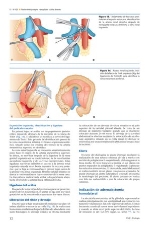 E – 41-020 Nefrectomía simple y ampliada a cielo abierto
A B
Figura 15. Aislamiento de los vasos arte-
riales en el espacio aortocava. Identiﬁcación
de la arteria renal derecha después de
rechazar la vena cava inferior y la vena renal
izquierda.
A B
Figura 16. Acceso renal izquierdo. Inci-
sión de la fascia de Toldt izquierda (A) y del
ligamento de Treitz (B) para identiﬁcar la
vena mesentérica inferior.
Exposición izquierda, identiﬁcación y ligadura
del pedículo vascular
En primer lugar, se realiza un despegamiento parieto-
cólico izquierdo después de la incisión de la fascia de
Toldt (Fig. 16). El duodeno se moviliza al nivel del liga-
mento de Treitz. Esto permite la identiﬁcación precoz de
la vena mesentérica inferior. El tronco esplenomesenté-
rico, situado justo por encima del tronco de la arteria
mesentérica superior, se identiﬁca.
La vena renal izquierda se encuentra anatómicamente
justo bajo el origen de la arteria mesentérica superior.
Se diseca, se moviliza después de la ligadura de la vena
genital izquierda en su borde inferior, de la vena lumbar
ascendente izquierda y de las venas suprarrenales. Estas
ligaduras sucesivas permiten el acceso a la arteria renal
izquierda situada en el borde superior de su cara poste-
rior, que se liga a continuación en primer lugar, antes de
la propia vena renal izquierda. El tejido celular linfático se
diseca a continuación en la cara anterior de la vena cava.
La disección se realiza hacia arriba y después hacia abajo,
hasta el nivel de la arteria ilíaca externa derecha.
Ligadura del uréter
Después de la incisión del peritoneo parietal posterior,
al nivel de los vasos ilíacos, el uréter se liga con los vasos
gonadales en la zona donde se cruza con los vasos ilíacos.
Liberación del ri˜nón y drenaje
Una vez que se han seccionado el pedículo vascular y el
uréter, el ri˜nón se extrae de su celda (Fig. 11). Se realiza una
hemostasia cuidadosa después del lavado abundante con
suero ﬁsiológico. El drenaje torácico se efectúa mediante
la colocación de un drenaje de tórax situado en el polo
superior de la cavidad pleural abierta. Se trata de un
drenaje de diámetro bastante grande que se mantiene
colocado durante 24-48 horas. El drenaje de la cavidad
abdominal se efectúa mediante la colocación de un dre-
naje aspirativo situado en la celda renal. El drenaje se
exterioriza por una contraincisión abdominal situada bajo
la incisión.
Cierre
El cierre del diafragma se puede efectuar mediante la
realización de una sutura continua de ida y vuelta con
un hilo de poliglactina 0 suspendiendo el diafragma en la
línea media. El cierre torácico se realiza en un plano con
puntos separados de poliglactina 0 englobando la pleura y
los músculos intercostales. El cierre de la pared abdominal
se realiza también en un plano con puntos separados. Se
puede efectuar un cierre subcutáneo teniendo en cuenta
la morfología del paciente. El cierre cutáneo se realiza
con hilo no reabsorbible o con la colocación de grapas
cutáneas.
Indicación de adrenalectomía
homolateral
La afectación metastásica de la glándula suprarrenal se
realiza principalmente por contigüidad, en contacto con
tumores voluminosos del polo superior del ri˜nón. Es más
frecuente cuando el tumor tiene un volumen importante
y cuando se sitúa en el polo superior del ri˜nón. La tasa
de invasión es del 1,2-10% según las series [33]
. La TC
12 EMC - Urología
 
