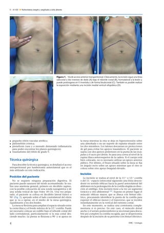 E – 41-020 Nefrectomía simple y ampliada a cielo abierto
A B C
D
Figura 1. Vía de acceso anterior transperitoneal. Clásicamente, la incisión sigue una línea
subcostal a dos traveses de dedo (A) bajo el reborde costal (B), homolateral a la lesión y
puede prolongarse en V invertida o de forma bisubcostal (C). También es posible realizar
la exposición mediante una incisión medial vertical xifopúbica (D).
• peque˜no ri˜nón vascular atróﬁco;
• pielonefritis crónica;
• pionefrosis (rara y a menudo demasiado inﬂamatoria
para poder encontrar los planos quirúrgicos);
• traumatismo del ri˜nón de grado V.
Técnica quirúrgica
Para describir la técnica quirúrgica, se detallará el acceso
retroperitoneal por lumbotomía anterolateral que es el
más utilizado en esta indicación.
Posición del paciente
No se requiere ninguna preparación digestiva. El
paciente puede rasurarse del modo acostumbrado. Se rea-
liza una anestesia general, primero en decúbito supino,
con la posible colocación de una sonda nasogástrica y de
una sonda vesical de tipo Foley 18 Ch. Una vez prepa-
rado, el paciente se coloca en decúbito lateral franco a
90◦
(Fig. 2), apoyado sobre el lado contralateral del ri˜nón
que se va a operar, en el medio de la mesa quirúrgica,
equidistante a los dos bordes.
La mesa se ﬂexiona para ampliar el espacio situado entre
la cresta ilíaca y el borde inferior de la 12.a
costilla. Puede
ser necesario colocar un rodillo bajo el reborde costal del
lado contralateral, particularmente si la reja costal des-
ciende mucho. La pierna se ﬂexiona a 90◦
y se apoya en
la mesa mientras la otra se deja en hiperextensión sobre
una almohada o en un soporte de espuma situado entre
los dos miembros. Los talones descansan en protecciones
de gel para evitar los apoyos traumáticos. El paciente se
sujeta con dos apoyos posteriores en la punta de las escá-
pulas y el sacro por detrás. Se pasa una correa al nivel de la
espina ilíaca anterosuperior de la cadera. Si el cuerpo está
bien colocado, no es necesario utilizar un apoyo anterior
púbico. Por último, el brazo situado sobre la mesa se ﬁja
en ángulo recto sobre un apoyo mientras que el otro se
coloca sobre otro apoyo braquial elevado.
Incisión
La incisión se realiza al nivel de la 11.a
o 12.a
costilla
o del 11.◦
espacio intercostal siguiendo una línea descen-
dente en sentido oblicuo hacia la pared anterolateral del
abdomen en la prolongación de la costilla elegida en direc-
ción al ombligo. Esta incisión tiene a la vez un segmento
torácico y otro abdominal [24]
. Expone en primer lugar el
músculo oblicuo mayor, que se diseca con bisturí eléc-
trico, procurando identiﬁcar la punta de la costilla para
exponer el oblicuo menor y el transverso, que se inciden
inmediatamente en la vertical del extremo costal.
En este momento, se realiza una costotomía comple-
mentaria si es preciso. En este caso, el músculo dorsal
ancho y el serrato posteroinferior se seccionan para descu-
brir por completo la costilla escogida, que se desperiostiza
después de la incisión de su periostio con bisturí eléctrico.
4 EMC - Urología
 