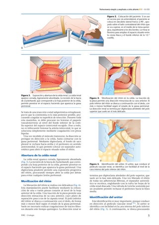 Nefrectomía simple y ampliada a cielo abierto E – 41-020
Figura 2. Colocación del paciente. Si se usa
un acceso por vía anterolateral, el paciente se
coloca en decúbito lateral franco a 90◦, apo-
yado sobre el lado contralateral del ri˜nón que
se va a operar, en el medio de la mesa quirúr-
gica, equidistante a los dos bordes. La mesa se
ﬂexiona para ampliar el espacio situado entre
la cresta ilíaca y el borde inferior de la 12.a
costilla.
Figura 3. Exposición y abertura de la celda renal. La celda renal
aparece cerrada, ligeramente abombada. La incisión de la fascia
de Zuckerkandl, que corresponde a la hoja posterior de la celda,
permite penetrar en el espacio haciendo que aparezca la grasa
perirrenal.
Se trata de una resección costal subperióstica extrapleural,
por lo que la costotomía es lo más posterior posible, pro-
curando coagular su superﬁcie de resección. Durante toda
esta maniobra, se debe procurar no lesionar el paquete
vasculonervioso al nivel del borde inferior de la costi-
lla superior del espacio intercostal escogido. Pese a todo,
no es infrecuente lesionar la arteria intercostal, lo que se
soluciona simplemente mediante coagulación con pinza
bipolar.
Una vez incidido el músculo transverso, la disección se
prosigue en dirección a la celda, hasta contactar con la
grasa perirrenal. Mediante digitoclasia, el fondo de saco
pleural se rechaza hacia arriba y el peritoneo en sentido
anteromedial, lo que permite colocar un separador auto-
estático para abrir el espacio situado sobre el ri˜nón.
Abertura de la celda renal
La celda renal aparece cerrada, ligeramente abombada
(Fig. 3). La incisión de la fascia de Zuckerkandl, que corres-
ponde a la hoja posterior de la celda, permite penetrar en
el espacio haciendo que aparezca la grasa perirrenal. Una
digitoclasia prudente permite una exposición progresiva
del ri˜nón, procurando siempre abrir la celda por detrás
para evitar cualquier lesión peritoneal.
Movilización del ri˜nón
La liberación del ri˜nón se realiza con delicadeza (Fig. 4).
Esta manipulación puede facilitarse mediante la coloca-
ción de una o varias pinzas corazón al nivel de la hoja
anterior de la celda. Una tracción de la pieza permite una
disección minuciosa de su cara anterior, cuyo plano de
separación pasa a ras de la cápsula renal. El polo inferior
del ri˜nón se diseca a continuación con el dedo, de forma
más o menos fácil según el estado de la grasa perirrenal.
Suele ser necesario realizar coagulaciones de tractos ﬁbro-
sos durante este tiempo quirúrgico. La disección renal se
Figura 4. Movilización del ri˜nón en la celda. La tracción de
la pieza permite una disección minuciosa de su cara anterior. El
polo inferior del ri˜nón se diseca a continuación con el dedo, con
más o menos facilidad según el estado de la grasa perirrenal.
La disección renal se termina por digitoclasia alrededor del polo
superior que suele ser el más delicado.
Figura 5. Identiﬁcación del uréter. El uréter, que conduce al
pedículo vascular renal, se identiﬁca con facilidad al nivel de la
cara interna del polo inferior del ri˜nón.
termina por digitoclasia alrededor del polo superior, que
suele ser la fase más delicada. Una vez liberado el ri˜nón
de todas sus adherencias ﬁbrosas, el separador autoestá-
tico se recoloca, englobando con la valva las hojas de la
celda renal disecada. Una válvula de Leriche sostenida por
un ayudante permite rechazar el peritoneo hacia la línea
media.
Identiﬁcación del uréter
Esta identiﬁcación es muy importante, porque conduce
en dirección al pedículo vascular renal [25]
. El uréter se
identiﬁca con facilidad en la cara interna del polo inferior
del ri˜nón (Fig. 5). A continuación, se diseca procurando
EMC - Urología 5
 
