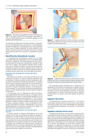 E – 41-020 Nefrectomía simple y ampliada a cielo abierto
Figura 6. Identiﬁcación del pedículo vascular. El pedículo vas-
cular se encuentra al nivel de la cara anterior de la pelvis. La
vena es el primer elemento que se identiﬁca, seguida, en cara
posterior, de la arteria renal.
no lesionar los elementos vasculares satélites y nutricios.
En caso de diﬁcultad para reconocerlo, su peristaltismo
permite distinguirlo, en particular de los vasos genitales
con los que se puede confundir. El uréter aislado de este
modo, se marca con un lazo vascular, tras lo que se diseca
hacia arriba en dirección a la pelvis y al pedículo vascular
renal.
Identiﬁcación del pedículo vascular
La identiﬁcación del pedículo vascular (Fig. 6) sigue
unas reglas diferentes dependiendo de si se trata del ri˜nón
derecho o izquierdo. De forma general, hay que inten-
tar identiﬁcar los elementos del pedículo vascular lo más
cerca de su origen. Esto permite seguirlos hasta el hilio
sin correr el riesgo de lesionar o de seccionar desafortu-
nadamente una de sus ramas. Siempre hay que tener en
cuenta la posible existencia de arterias polares superiores
o inferiores que nacen muy cerca del origen de la aorta.
Identiﬁcación del pedículo vascular del ri˜nón
izquierdo
Este pedículo vascular se encuentra al nivel de la cara
anterior de la pelvis. La vena es el primer elemento que
se identiﬁca. La disección debe ser ﬁna y meticulosa, pro-
curando no lesionar los elementos del pedículo. Se realiza
hacia la línea media para descubrir las venas suprarrena-
les y genitales (particularidad que no existe en el lado
derecho) (cf supra «Anatomía modal»). A continuación,
la vena genital, la vena lumbar ascendente izquierda por
abajo y la vena suprarrenal por arriba se aíslan, se ligan y
se seccionan.
La vena renal, una vez liberada de todas sus tributa-
rias (dependientes del sistema ácigos) se rechaza con un
separador de Gil Vernet, lo que permite identiﬁcar, en su
cara posterior, la arteria renal izquierda [26]
. Esta se diseca
situándose directamente en contacto con la pared arterial
después de haber incidido el tejido celular que la rodea
(cf supra «Anatomía modal»). Una vez disecados los ele-
mentos del pedículo vascular e identiﬁcados con un lazo
(preferentemente, de silicona), la atención se dirige a la
disección de la cara posterior del ri˜nón.
Identiﬁcación del pedículo vascular del ri˜nón
derecho
El mejor método es situarse directamente en la cara
anterior de la vena cava después de haber rechazado el
duodeno en sentido medial. A continuación, la cara ante-
rior de la vena cava se diseca hasta la terminación de la
cara anterior de la vena renal derecha, que se diseca cui-
dadosamente en un primer tiempo por su borde superior
y, después, por el inferior. Se coloca un lazo vascular. Las
colaterales venosas son menos importantes, pero la disec-
ción de esta vena renal debe efectuarse adecuadamente
para identiﬁcarlas y ligarlas en ocasiones.
Figura 7. Ligadura del uréter. El uréter se retoma y se diseca
hacia abajo en dirección al cruce con los vasos ilíacos, tras lo que
se liga y se secciona a este nivel.
Figura 8. Ligadura de la arteria renal. La arteria renal, en la cara
posterior de la vena, es el primer elemento que se liga para evitar
el riesgo de turgencia renal por bloqueo del retorno venoso.
Esta maniobra puede facilitarse por la utilización de
separadores de Gil Vernet colocados en la región cavorre-
nal. La utilización de estos separadores permite también,
al separar la vena renal derecha, encontrar, en la parte
posterosuperior, la arteria renal derecha, que se diseca a
continuación y se sigue lo más lejos posible de lateral a
medial.
Ligadura del uréter
A continuación, se retoma el uréter (Fig. 7) y se diseca
hacia abajo, en dirección a su cruce con los vasos ilíacos,
tras lo que se liga con un hilo reabsorbible (un clip puede
servir de referencia radiopaca si es preciso) y se secciona a
este nivel.
Ligadura selectiva de los vasos
La ligadura del pedículo vascular debe realizarse prefe-
rentemente de forma selectiva, primero la arteria (Fig. 8),
para evitar el riesgo de turgencia renal por bloqueo del
retorno venoso (si se hiciese la ligadura venosa primero) y
de posibles hemorragias posteriores de colaterales venosas
difíciles de controlar una vez seccionada la vena principal
(si se realiza una ligadura en masa poco precisa). Sin
embargo, en algunas circunstancias, no siempre puede
emplearse esta estrategia y debe optarse por una técnica
alternativa de ligadura en masa. Las técnicas se describen
6 EMC - Urología
 