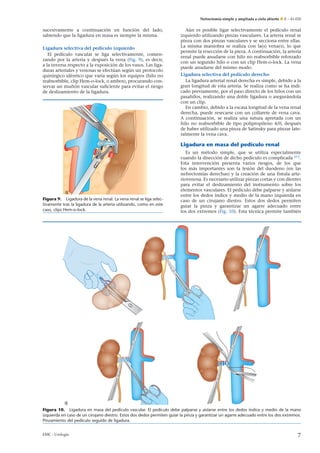 Nefrectomía simple y ampliada a cielo abierto E – 41-020
sucesivamente a continuación en función del lado,
sabiendo que la ligadura en masa es siempre la misma.
Ligadura selectiva del pedículo izquierdo
El pedículo vascular se liga selectivamente, comen-
zando por la arteria y después la vena (Fig. 9), es decir,
a la inversa respecto a la exposición de los vasos. Las liga-
duras arteriales y venosas se efectúan según un protocolo
quirúrgico idéntico que varía según los equipos (hilo no
reabsorbible, clip Hem-o-lock, o ambos), procurando con-
servar un mu˜nón vascular suﬁciente para evitar el riesgo
de deslizamiento de la ligadura.
Figura 9. Ligadura de la vena renal. La vena renal se liga selec-
tivamente tras la ligadura de la arteria utilizando, como en este
caso, clips Hem-o-lock.
Aún es posible ligar selectivamente el pedículo renal
izquierdo utilizando pinzas vasculares. La arteria renal se
pinza con dos pinzas vasculares y se secciona entre ellas.
La misma maniobra se realiza con la(s) vena(s), lo que
permite la resección de la pieza. A continuación, la arteria
renal puede anudarse con hilo no reabsorbible reforzado
con un segundo hilo o con un clip Hem-o-lock. La vena
puede anudarse del mismo modo.
Ligadura selectiva del pedículo derecho
La ligadura arterial renal derecha es simple, debido a la
gran longitud de esta arteria. Se realiza como se ha indi-
cado previamente, por el paso directo de los hilos con un
pasahílos, realizando una doble ligadura o asegurándola
con un clip.
En cambio, debido a la escasa longitud de la vena renal
derecha, puede resecarse con un collarete de vena cava.
A continuación, se realiza una sutura apretada con un
hilo no reabsorbible de tipo polipropileno 4/0, después
de haber utilizado una pinza de Satinsky para pinzar late-
ralmente la vena cava.
Ligadura en masa del pedículo renal
Es un método simple, que se utiliza especialmente
cuando la disección de dicho pedículo es complicada [27]
.
Esta intervención presenta varios riesgos, de los que
los más importantes son la lesión del duodeno (en las
nefrectomías derechas) y la creación de una fístula arte-
riovenosa. Es necesario utilizar pinzas cortas y con dientes
para evitar el deslizamiento del instrumento sobre los
elementos vasculares. El pedículo debe palparse y aislarse
entre los dedos índice y medio de la mano izquierda en
caso de un cirujano diestro. Estos dos dedos permiten
guiar la pinza y garantizar un agarre adecuado entre
los dos extremos (Fig. 10). Esta técnica permite también
Figura 10. Ligadura en masa del pedículo vascular. El pedículo debe palparse y aislarse entre los dedos índice y medio de la mano
izquierda en caso de un cirujano diestro. Estos dos dedos permiten guiar la pinza y garantizar un agarre adecuado entre los dos extremos.
Pinzamiento del pedículo seguido de ligadura.
EMC - Urología 7
 