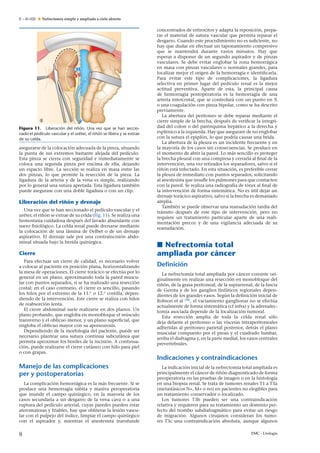 E – 41-020 Nefrectomía simple y ampliada a cielo abierto
Figura 11. Liberación del ri˜nón. Una vez que se han seccio-
nado el pedículo vascular y el uréter, el ri˜nón se libera y se extrae
de su celda.
asegurarse de la colocación adecuada de la pinza, situando
la punta de sus extremos bastante alejada del pedículo.
Esta pinza se cierra con seguridad e inmediatamente se
coloca una segunda pinza por encima de ella, dejando
un espacio libre. La sección se realiza en masa entre las
dos pinzas, lo que permite la resección de la pieza. La
ligadura de la arteria y de la vena es simple, realizando
por lo general una sutura apretada. Esta ligadura también
puede asegurase con una doble ligadura o con un clip.
Liberación del ri˜nón y drenaje
Una vez que se han seccionado el pedículo vascular y el
uréter, el ri˜nón se extrae de su celda (Fig. 11). Se realiza una
hemostasia cuidadosa después del lavado abundante con
suero ﬁsiológico. La celda renal puede drenarse mediante
la colocación de una lámina de Delbet o de un drenaje
aspirativo. El drenaje sale por una contraincisión abdo-
minal situada bajo la herida quirúrgica.
Cierre
Para efectuar un cierre de calidad, es necesario volver
a colocar al paciente en posición plana, horizontalizando
la mesa de operaciones. El cierre torácico se efectúa por lo
general en un plano, aproximando toda la pared muscu-
lar con puntos separados, si se ha realizado una resección
costal; en el caso contrario, el cierre es sencillo, pasando
los hilos por el extremo de la 11.a
o 12.a
costilla, depen-
diendo de la intervención. Este cierre se realiza con hilos
de reabsorción lenta.
El cierre abdominal suele realizarse en dos planos. Un
plano profundo, que engloba en monobloque el músculo
transverso y el oblicuo menor, y un plano superﬁcial, que
engloba el oblicuo mayor con su aponeurosis.
Dependiendo de la morfología del paciente, puede ser
necesario plantear una sutura continua subcutánea que
permita aproximar los bordes de la incisión. A continua-
ción, puede realizarse el cierre cutáneo con hilo para piel
o con grapas.
Manejo de las complicaciones
per y postoperatorias
La complicación hemorrágica es la más frecuente. Si se
produce una hemorragia súbita y masiva peroperatoria
que inunde el campo quirúrgico, en la mayoría de los
casos secundaria a un desgarro de la vena cava o a una
ruptura del pedículo arterial, cuyas paredes pueden estar
ateromatosas y friables, hay que obliterar la lesión vascu-
lar con el pulpejo del índice, limpiar el campo quirúrgico
con el aspirador y, mientras el anestesista transfunde
concentrados de eritrocitos y adapta la reposición, prepa-
rar el material de sutura vascular que permita reparar el
desgarro. Cuando este procedimiento no es suﬁciente, no
hay que dudar en efectuar un taponamiento compresivo
que se mantendrá durante varios minutos. Hay que
esperar a disponer de un segundo aspirador y de pinzas
vasculares. Se debe evitar englobar la zona hemorrágica
en masa con pinzas vasculares o normales grandes, para
localizar mejor el origen de la hemorragia e identiﬁcarla.
Para evitar este tipo de complicaciones, la ligadura
selectiva en primer lugar del pedículo renal es la mejor
actitud preventiva. Aparte de esta, la principal causa
de hemorragia postoperatoria es la hemorragia de una
arteria intercostal, que se controlará con un punto en X
o una coagulación con pinza bipolar, como se ha descrito
previamente.
La abertura del peritoneo se debe reparar mediante el
cierre simple de la brecha, después de veriﬁcar la integri-
dad del colon o del parénquima hepático a la derecha y
esplénico a la izquierda. Hay que asegurare de no englobar
con la sutura el epiplón, lo que podría causar una brida.
La abertura de la pleura es un incidente frecuente y en
la mayoría de los casos sin consecuencias. Se produce en
el momento de abrir la pared. Lo más sencillo es proteger
la brecha pleural con una compresa y cerrarla al ﬁnal de la
intervención, una vez retirados los separadores, salvo si el
ri˜nón está infectado. En esta situación, es preferible cerrar
la pleura de inmediato con puntos separados, solicitando
al anestesista que insuﬂe los pulmones para que contacten
con la pared. Se realiza una radiografía de tórax al ﬁnal de
la intervención de forma sistemática. No es útil dejar un
drenaje torácico aspirativo, salvo si la brecha es demasiado
amplia.
También se puede observar una reanudación tardía del
tránsito después de este tipo de intervención, pero no
requiere un tratamiento particular aparte de una reali-
mentación precoz y de una vigilancia adecuada de su
reanudación.
Nefrectomía total
ampliada por cáncer
Definición
La nefrectomía total ampliada por cáncer consiste ori-
ginalmente en realizar una resección en monobloque del
ri˜nón, de la grasa peritoneal, de la suprarrenal, de la fascia
de Gerota y de los ganglios linfáticos regionales depen-
dientes de los grandes vasos. Según la deﬁnición inicial de
Robson et al [28]
, el vaciamiento ganglionar no se efectúa
actualmente de forma sistemática (cf infra) y la adrenalec-
tomía asociada depende de la localización tumoral.
Esta resección amplia de toda la celda renal sólo
deja delante el peritoneo o las vísceras intraperitoneales
adheridas al peritoneo parietal posterior, detrás el plano
muscular compuesto por el psoas y el cuadrado lumbar,
arriba el diafragma y, en la parte medial, los vasos centrales
prevertebrales.
Indicaciones y contraindicaciones
La indicación inicial de la nefrectomía total ampliada es
principalmente el cáncer de ri˜nón diagnosticado de forma
preoperatoria en las pruebas de imagen o en la histología
en una biopsia renal. Se trata de tumores renales T1 a T3a
(metastásicos N+, M+ o no) en pacientes no elegibles para
un tratamiento conservador o localizado.
Los tumores T3b pueden ser una contraindicación
relativa y requieren para su tratamiento un dominio per-
fecto del trombo subdiafragmático para evitar un riesgo
de migración. Algunos cirujanos consideran los tumo-
res T3c una contraindicación absoluta, aunque algunos
8 EMC - Urología
 
