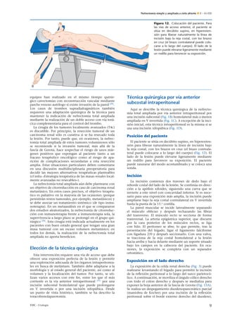 Nefrectomía simple y ampliada a cielo abierto E – 41-020
Figura 12. Colocación del paciente. Para
las vías de acceso anterior, el paciente se
sitúa en decúbito supino, en hiperexten-
sión para liberar naturalmente la línea de
incisión bajo la reja costal, con los brazos
en cruz (el brazo contralateral puede colo-
carse a lo largo del cuerpo). El lado de la
lesión puede elevarse ligeramente mediante
un rodillo para favorecer su exposición.
equipos han realizado en el mismo tiempo quirúr-
gico cavectomías con reconstrucción vascular mediante
parche venoso autólogo si existe invasión de la pared [29]
.
Los casos de trombos supradiafragmáticos también
requieren una adaptación quirúrgica de la técnica para
mantener la indicación de nefrectomía total ampliada
mediante la realización de un doble acceso con vía torá-
cica complementaria para el control del trombo.
La cirugía de los tumores localmente avanzados (T4c)
es discutible. Por principio, la resección tumoral de un
carcinoma renal sólo es curativa si se ha resecado toda
la lesión. Por tanto, puede que, en ocasiones, la nefrec-
tomía total ampliada de estos tumores voluminosos sólo
se recomiende si la invasión tumoral, más allá de la
fascia de Gerota, hace sospechar el riesgo de unos már-
genes positivos que expongan al paciente tanto a un
fracaso terapéutico oncológico como al riesgo de apa-
rición de complicaciones secundarias a esta resección
amplia. Estas situaciones particulares deben comentarse
en una discusión multidisciplinaria preoperatoria para
decidir las mejores alternativas terapéuticas planteables
(cf infra «Estrategia terapéutica de las masas renales local-
mente avanzadas no resecables»).
La nefrectomía total ampliada aún debe plantearse con
un objetivo de citorreducción en caso de carcinoma renal
metastásico. En estos casos precisos, el objetivo terapéu-
tico es paliativo en la mayoría de las ocasiones (porque
persistirán restos tumorales, por ejemplo, metastásicos) y
se debe asociar un tratamiento sistémico (de tipo inmu-
noterapia). En un metaanálisis en el que se compararon
dos estudios aleatorizados, la nefrectomía de citorreduc-
ción con inmunoterapia frente a inmunoterapia sola, la
supervivencia a largo plazo se prolongó en el grupo qui-
rúrgico [30]
. Esta cirugía está indicada actualmente en los
pacientes con buen estado general que tengan una gran
masa tumoral con un escaso volumen metastásico; en
todos los demás, la realización de la nefrectomía total
ampliada no aporta beneﬁcios.
Elección de la técnica quirúrgica
Esta intervención requiere una vía de acceso que debe
ofrecer una exposición perfecta de la lesión y permitir
una exploración adecuada de los órganos intraperitonea-
les en busca de metástasis. También debe adaptarse a la
morfología y al estado general del paciente, así como al
volumen y la localización del tumor. Por tanto, se uti-
lizan varios accesos con este ﬁn, entre los que el más
corriente es la vía anterior intraperitoneal [31]
por una
incisión subcostal homolateral que puede prolongarse
en V invertida o por una incisión xifopúbica. Desde
un punto de vista histórico, también se ha descrito la
toracofrenolaparotomía.
Técnica quirúrgica por vía anterior
subcostal intraperitoneal
Aquí se describe la técnica quirúrgica de la nefrecto-
mía total ampliada por vía anterior intraperitoneal por
una incisión subcostal (Fig. 1B) homolateral más o menos
ampliada en V invertida (Fig. 1C). A excepción de la inci-
sión inicial, esta técnica intraperitoneal es la misma si se
usa una incisión xifopúbica (Fig. 1D).
Posición del paciente
El paciente se sitúa en decúbito supino, en hiperexten-
sión para liberar naturalmente la línea de incisión bajo
la reja costal, con los brazos en cruz (el brazo contrala-
teral puede colocarse a lo largo del cuerpo) (Fig. 12). El
lado de la lesión puede elevarse ligeramente mediante
un rodillo para favorecer su exposición. El paciente
puede rasurarse del modo acostumbrado y se coloca una
sonda.
Incisión
La incisión comienza dos traveses de dedo bajo el
reborde costal del lado de la lesión. Se continúa en direc-
ción a la apóﬁsis xifoides, siguiendo una curva que se
invierte a este nivel con concavidad inferior. Si es nece-
sario para una exposición más amplia, la incisión puede
ampliarse bajo la reja costal contralateral en V invertida
hasta la punta de la 11.a
costilla.
La pared muscular se incide lateralmente separando
el músculo oblicuo y después rechazando las ﬁbras
del transverso. El músculo recto se secciona de forma
transversal. La arteria epigástrica superior, que discurre
por la cara posterior de los músculos rectos, se liga
con hilo. El peritoneo se abre, lo que permite, tras la
presentación del hígado, ligar el ligamento falciforme
con ligadura 2/0 y después seccionarlo. Con una valva,
se tracciona de la reja costal homolateral a la lesión
hacia arriba y hacia delante mediante un soporte situado
bajo los campos en la cabecera del paciente. En oca-
siones, la exposición se completa con un separador
ortostático.
Exposición en el lado derecho
La exposición de la celda renal derecha (Fig. 3) puede
realizarse levantando el hígado para permitir la incisión
de la reﬂexión peritoneal a lo largo del surco parietocó-
lico. A continuación, se moviliza el ángulo cólico derecho
con todo el colon derecho y después se medializa para
exponer la hoja anterior de la fascia de Gerota (Fig. 13A).
Se realiza un despegamiento duodenopancreático parcial
(maniobra de Kocher) por una incisión de la reﬂexión
peritoneal sobre el borde externo derecho del duodeno,
EMC - Urología 9
 
