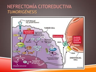 NEFRECTOMÍA CITOREDUCTIVA 
TUMORIGÉNESIS 
 