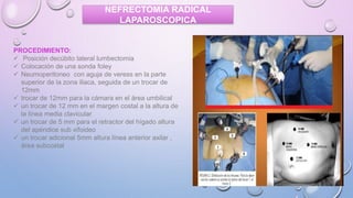 Nefrectomia convencional y laparoscopico | PPTX