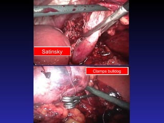 Satinsky Clamps bulldog 