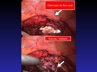 Colocação de flow-seal Suturas / bolsters 