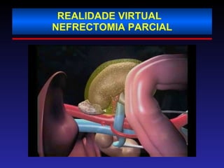 REALIDADE VIRTUAL  NEFRECTOMIA PARCIAL 