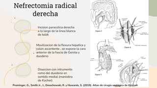 Nefrectomia radical.pptx