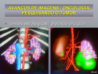 AVANÇOS DE IMAGENS / ONCOLOGIA PESQUISANDO O TUMOR Limites estratégicos / precisão cirúrgica IRCAD 