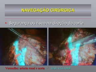 NAVEGAÇÃO CIRÚRGICA Segurança ou risco na direção do corte Vermelho: arteria renal e aorta   /  azul: veia renal 