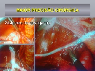 MAIOR PRECISÃO CIRÚRGICA Sistemas de navegação 