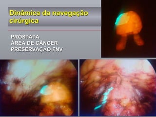 Dinâmica da navegação cirúrgica PRÓSTATA  ÁREA DE CÂNCER PRESERVAÇÃO FNV 