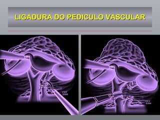 LIGADURA DO PEDICULO VASCULAR 