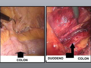 COLON DUODENO COLON 