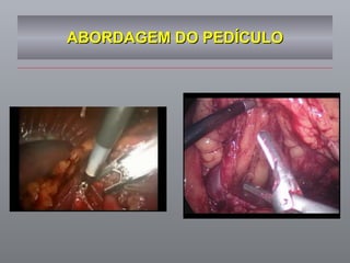 ABORDAGEM DO PEDÍCULO 