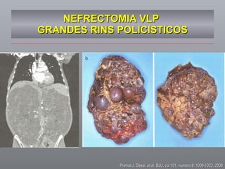 NEFRECTOMIA VLP  GRANDES RINS POLICISTICOS Premal J. Desai, et al. BJU, vol 101, numero 8, 1009-1023, 2008 
