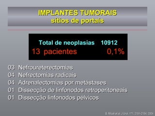 IMPLANTES TUMORAIS sítios de portais Total de neoplasias  10912 13  pacientes  0,1% 03  Nefroureterectomias 04  Nefrectomias radicais 04  Adrenalectomias por metástases 01  Dissecção de linfonodos retroperitoneais 01 Dissecção linfonodos pélvicos S. Micali et al, J Urol, 171, 2151-2154, 2004 