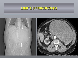 LIMITES / CIRURGIAS Ralph Clayman, Renal Update Course, AUA - 2008 