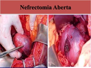 Nefrectomia Aberta
 