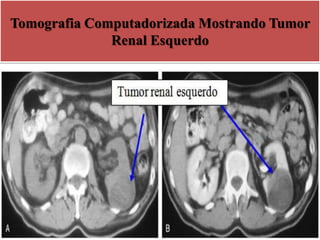 Tomografia Computadorizada Mostrando Tumor
Renal Esquerdo
 