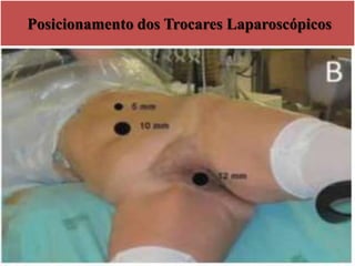 Posicionamento dos Trocares Laparoscópicos
 