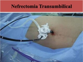Nefrectomia Transumbilical
 