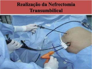 Realização da Nefrectomia
Transumbilical
 