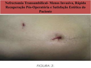 Nefrectomia Transumbilical- Menos Invasiva, Rápida
Recuperação Pós-Operatória e Satisfação Estética do
Paciente
 