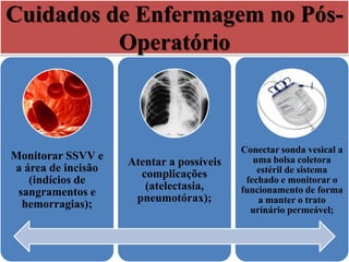 Cuidados de Enfermagem no Pós-
Operatório
Monitorar SSVV e
a área de incisão
(indícios de
sangramentos e
hemorragias);
Atentar a possíveis
complicações
(atelectasia,
pneumotórax);
Conectar sonda vesical a
uma bolsa coletora
estéril de sistema
fechado e monitorar o
funcionamento de forma
a manter o trato
urinário permeável;
 