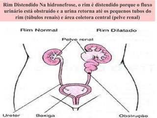 Rim Distendido Na hidronefrose, o rim é distendido porque o fluxo
urinário está obstruído e a urina retorna até os pequenos tubos do
rim (túbulos renais) e área coletora central (pelve renal)
 