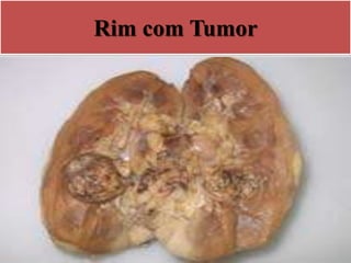 Rim com Tumor
 