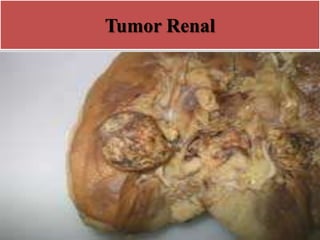 Tumor Renal
 