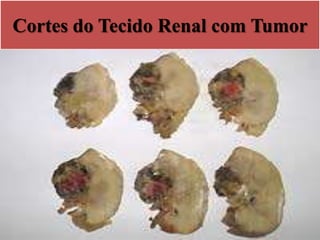 Cortes do Tecido Renal com Tumor
 