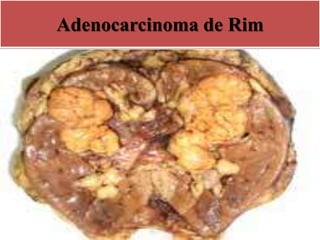 Adenocarcinoma de Rim
 