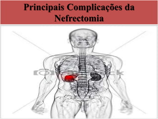 Principais Complicações da
Nefrectomia
 