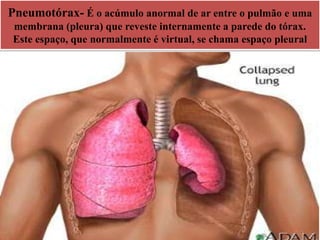 Pneumotórax- É o acúmulo anormal de ar entre o pulmão e uma
membrana (pleura) que reveste internamente a parede do tórax.
Este espaço, que normalmente é virtual, se chama espaço pleural
 
