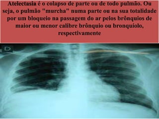 Atelectasia é o colapso de parte ou de todo pulmão. Ou
seja, o pulmão "murcha" numa parte ou na sua totalidade
por um bloqueio na passagem do ar pelos brônquios de
maior ou menor calibre brônquio ou bronquíolo,
respectivamente
 