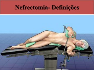 Nefrectomia- Definições
 