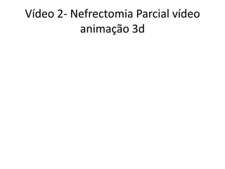 Vídeo 2- Nefrectomia Parcial vídeo
animação 3d
 