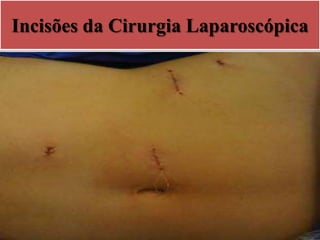 Incisões da Cirurgia Laparoscópica
 