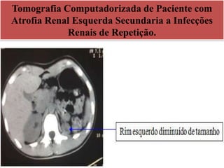 Tomografia Computadorizada de Paciente com
Atrofia Renal Esquerda Secundaria a Infecções
Renais de Repetição.
 