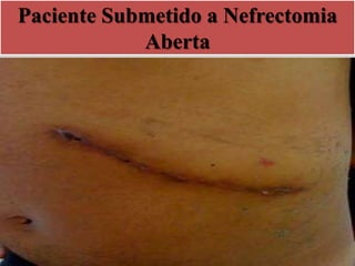 Paciente Submetido a Nefrectomia
Aberta
 