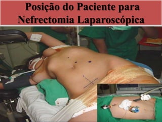 Posição do Paciente para
Nefrectomia Laparoscópica
 
