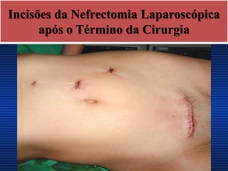 Incisões da Nefrectomia Laparoscópica
após o Término da Cirurgia
 
