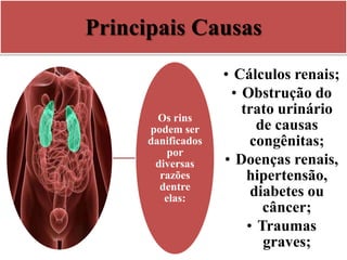 Principais Causas
Os rins
podem ser
danificados
por
diversas
razões
dentre
elas:
• Cálculos renais;
• Obstrução do
trato urinário
de causas
congênitas;
• Doenças renais,
hipertensão,
diabetes ou
câncer;
• Traumas
graves;
 