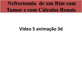 Nefrectomia de um Rim com
Tumor e com Cálculos Renais
Vídeo 5 animação 3d
 