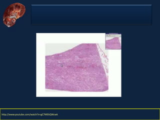 Nefritis Intersticial. Obed Rubio