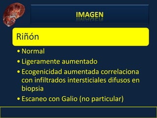 Nefritis Intersticial. Obed Rubio